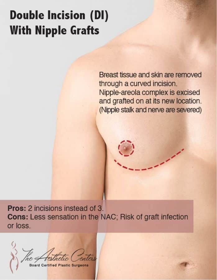 Female To Male FTM Top Surgery | Newport Beach Orange County