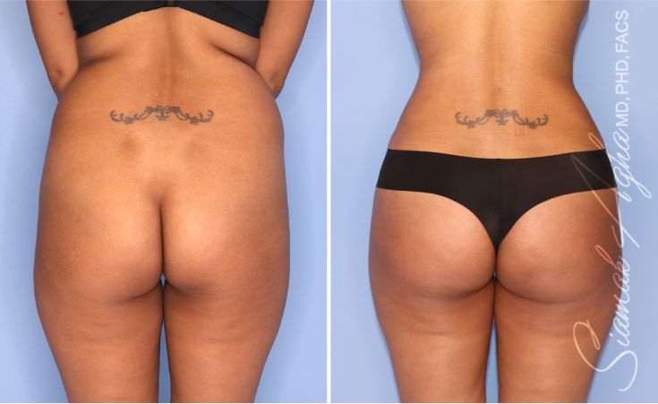 Before and after body contouring results.