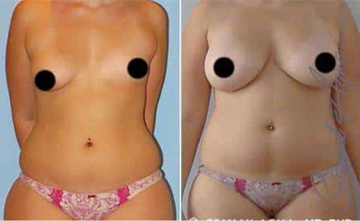 Before and after body transformation comparison.