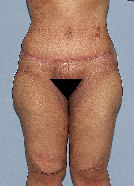 Body image post-surgery, focused on thighs and abdomen.