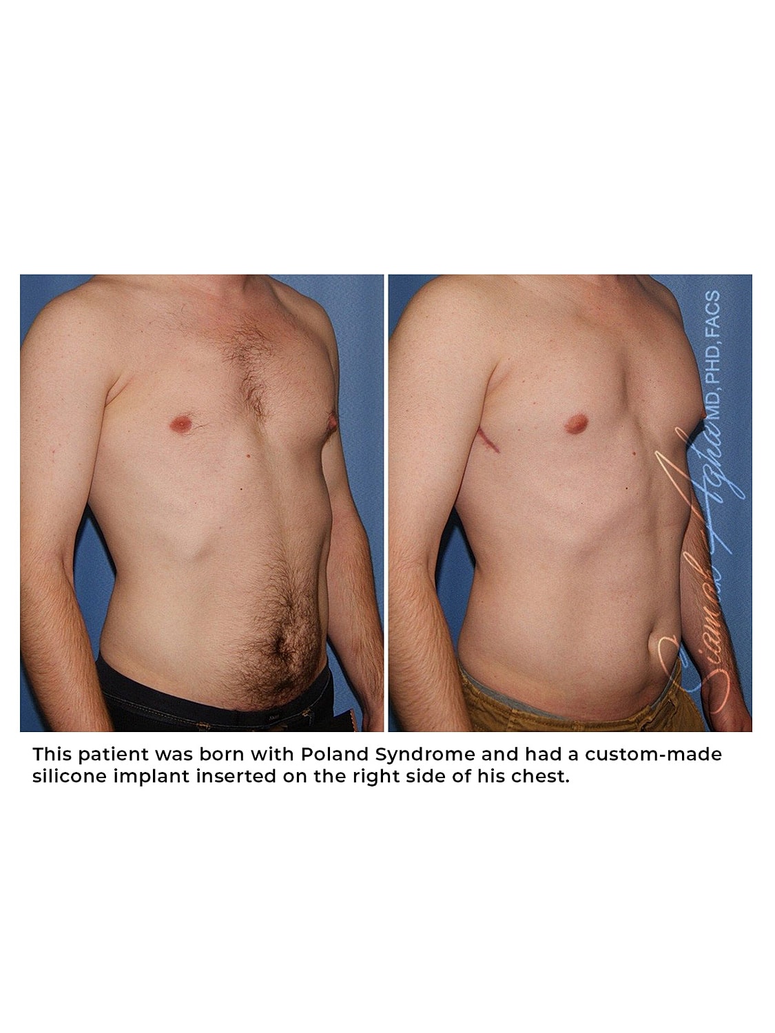 Chest photos showing surgery due to Poland Syndrome.