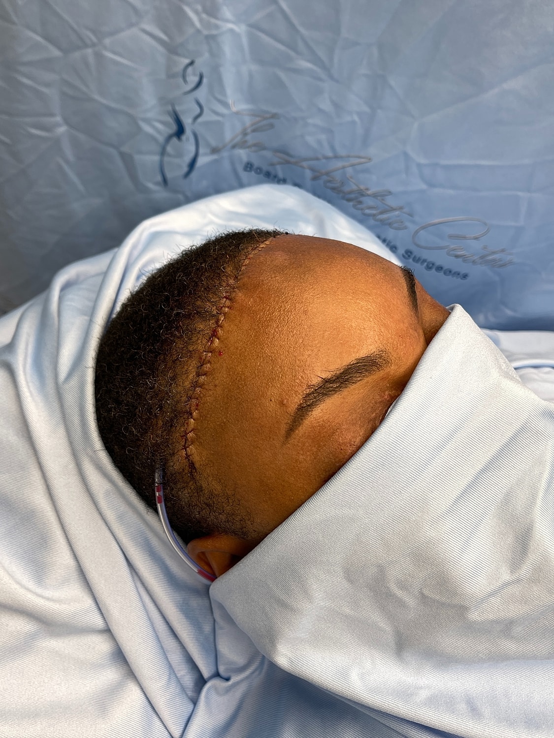 Patient recovering from hair restoration surgery.