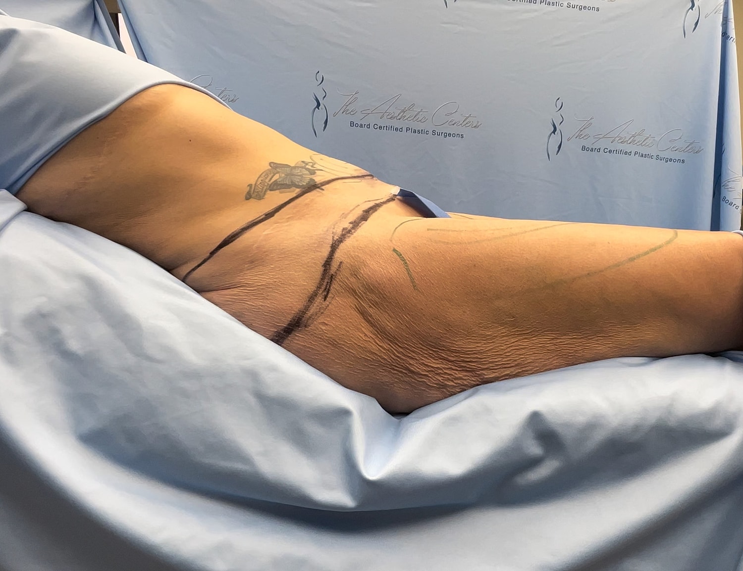 Patient preparation for plastic surgery procedure.