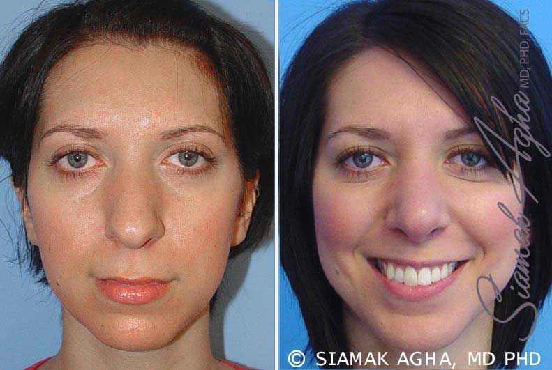Chin Augmentation Before & After