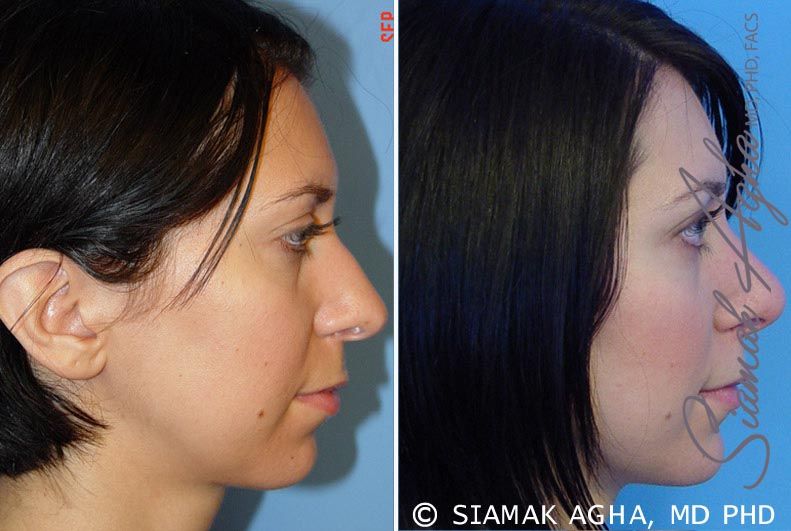Chin Augmentation Before & After