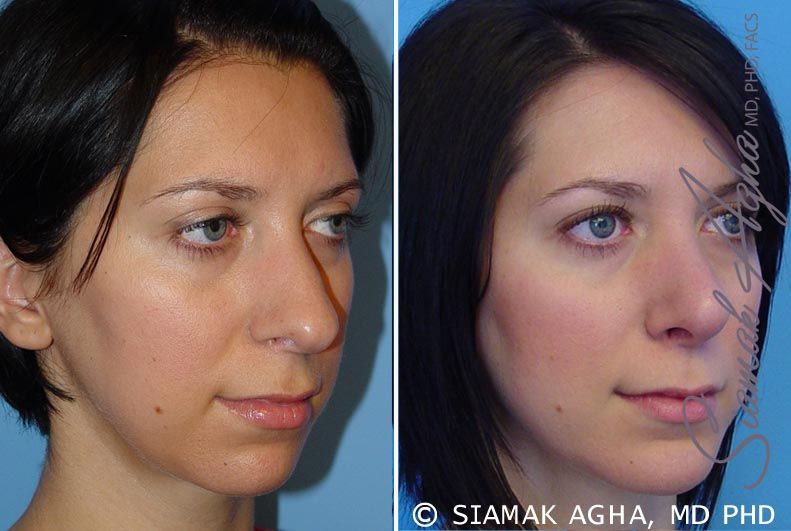 Chin Augmentation Before & After