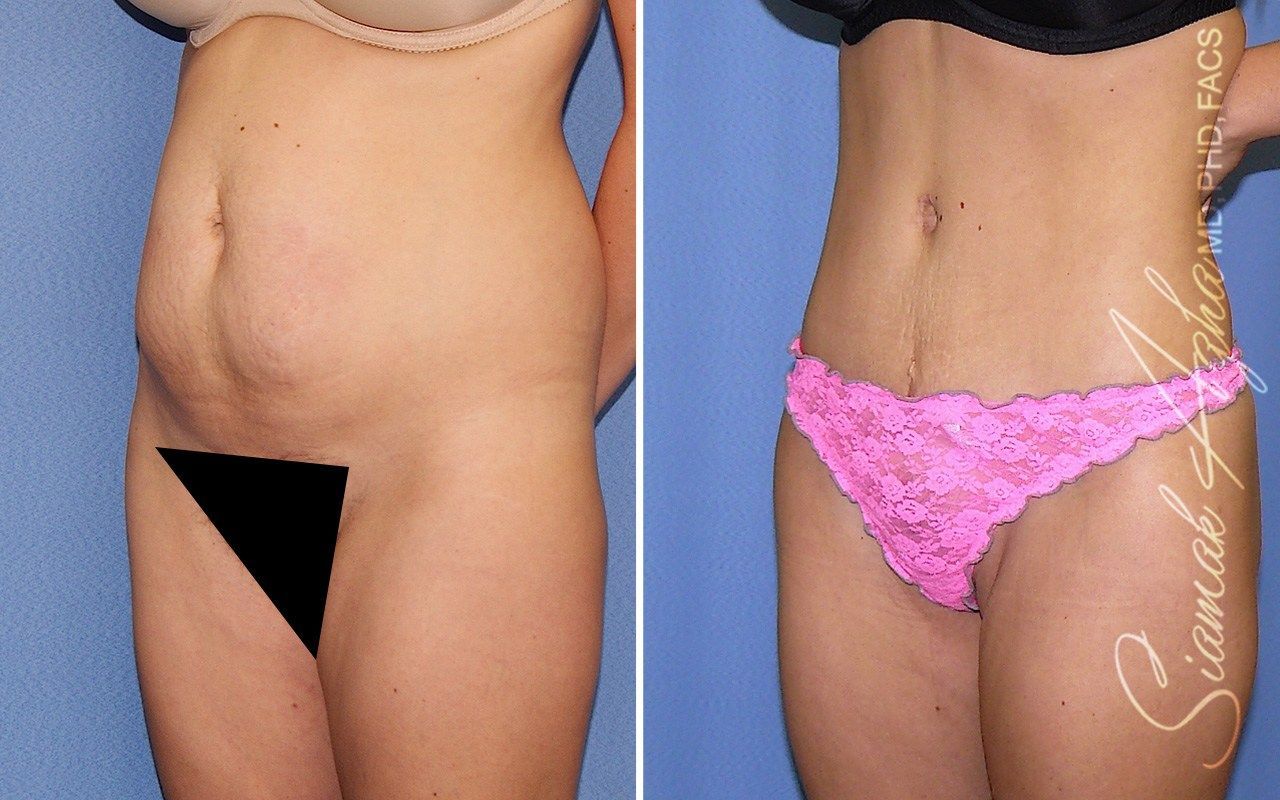 Combined Tummy Tuck Brazilian Butt Lift Before & After