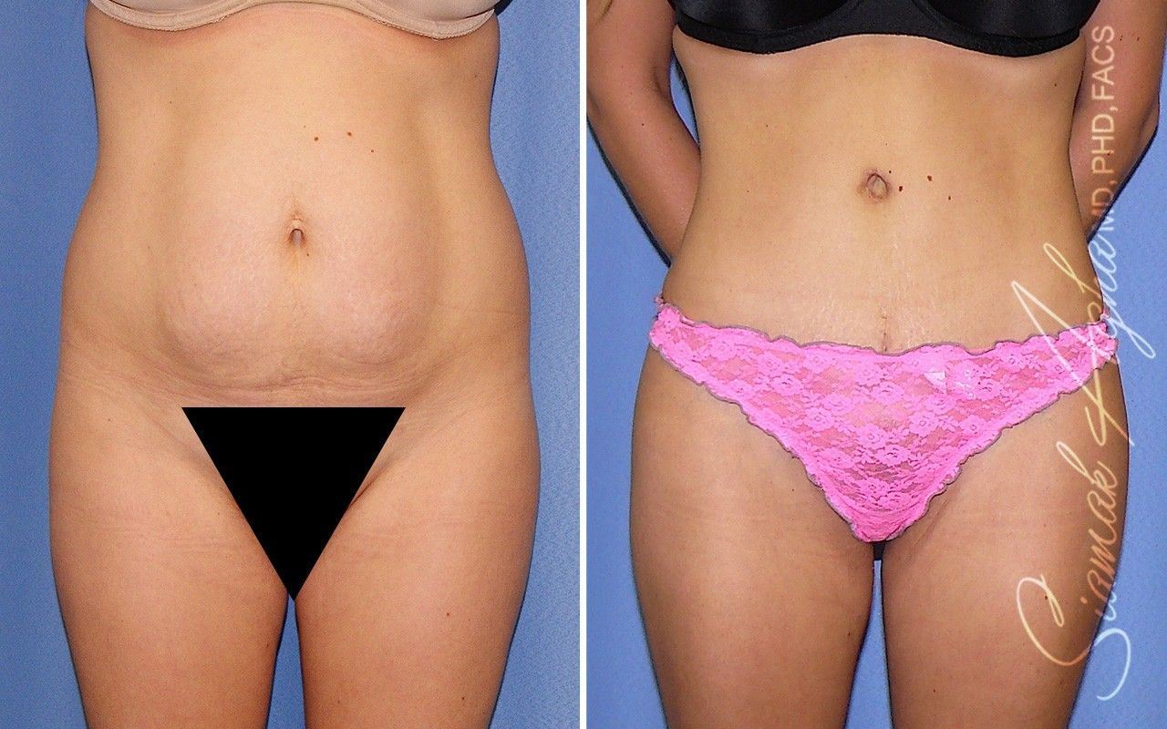 Combined Tummy Tuck Brazilian Butt Lift Before & After
