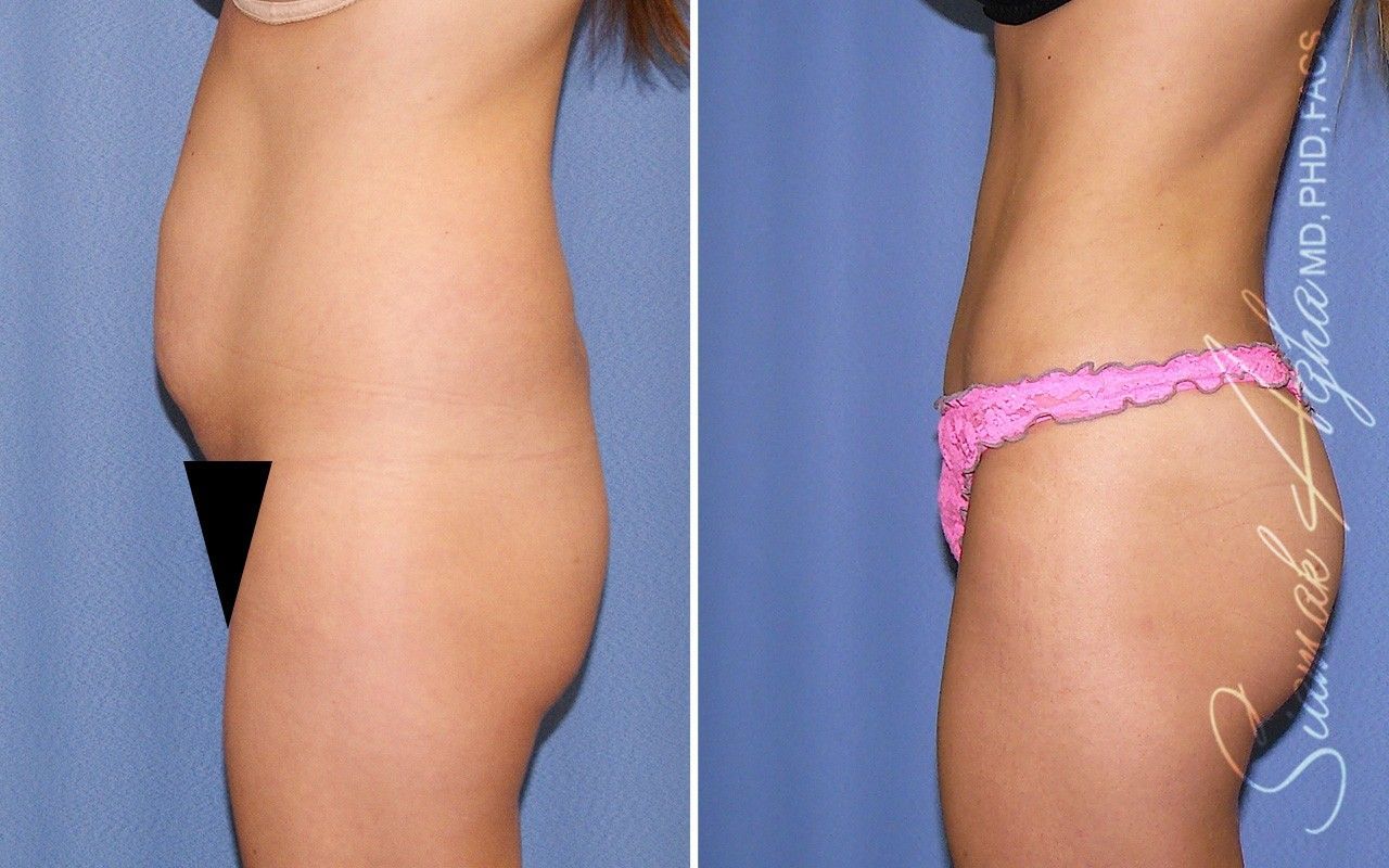 Combined Tummy Tuck Brazilian Butt Lift Before & After