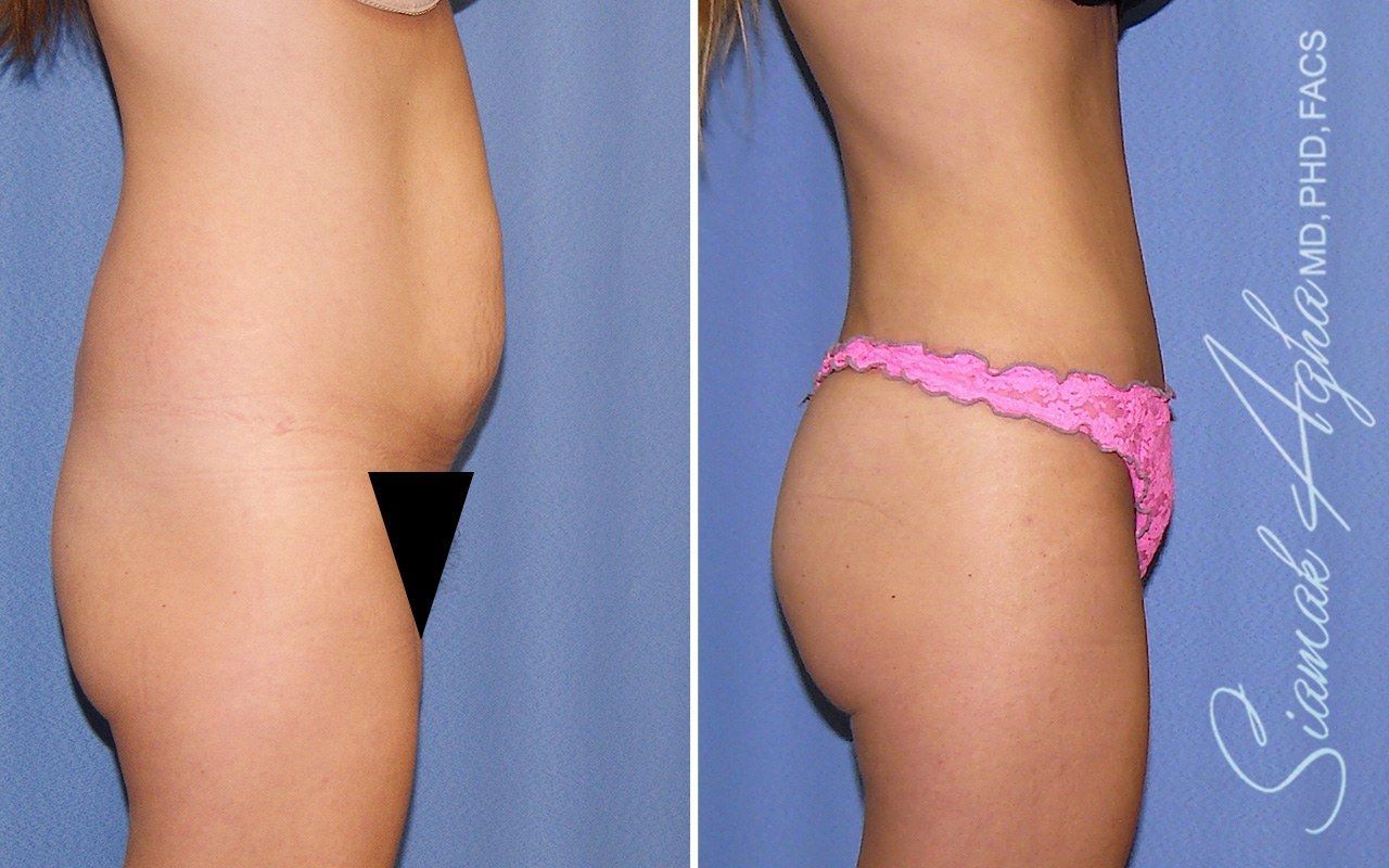 Combined Tummy Tuck Brazilian Butt Lift Before & After