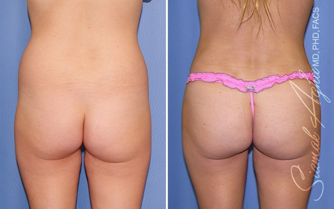Combined Tummy Tuck Brazilian Butt Lift Before & After