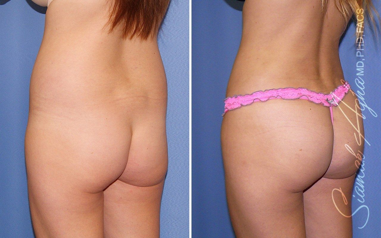 Combined Tummy Tuck Brazilian Butt Lift Before & After