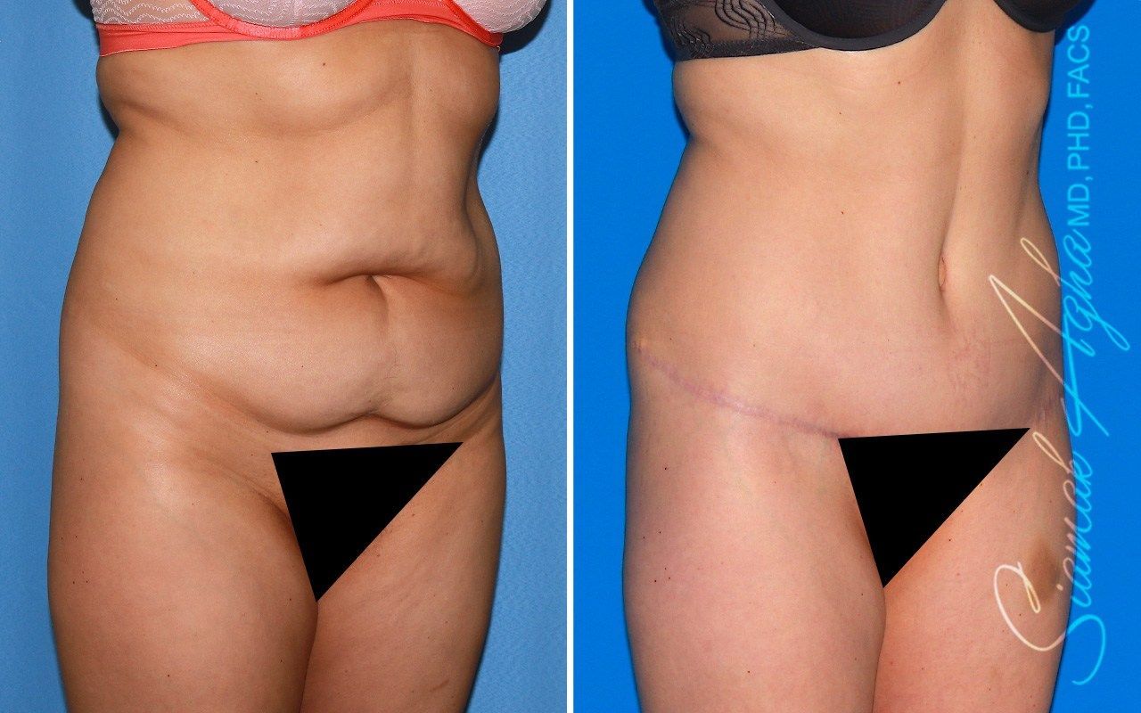 Combined Tummy Tuck Brazilian Butt Lift Before & After