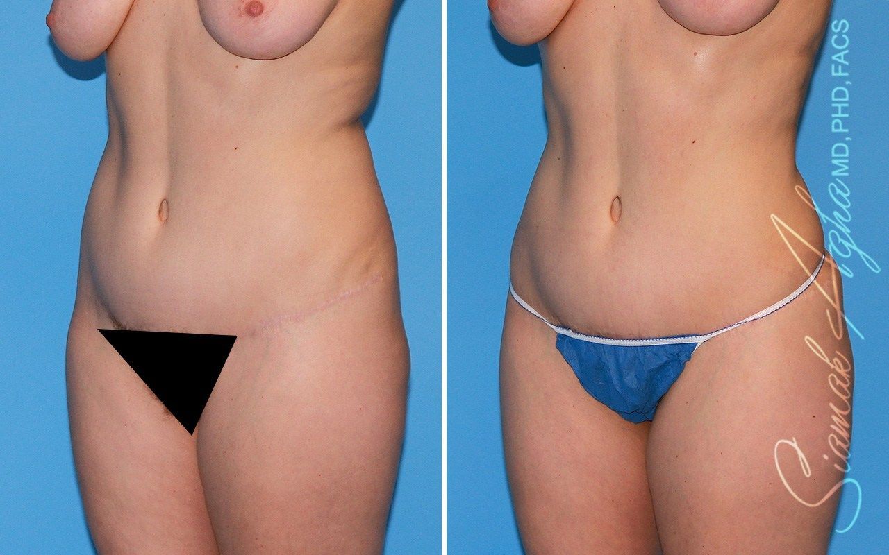 Combined Tummy Tuck Brazilian Butt Lift Before & After