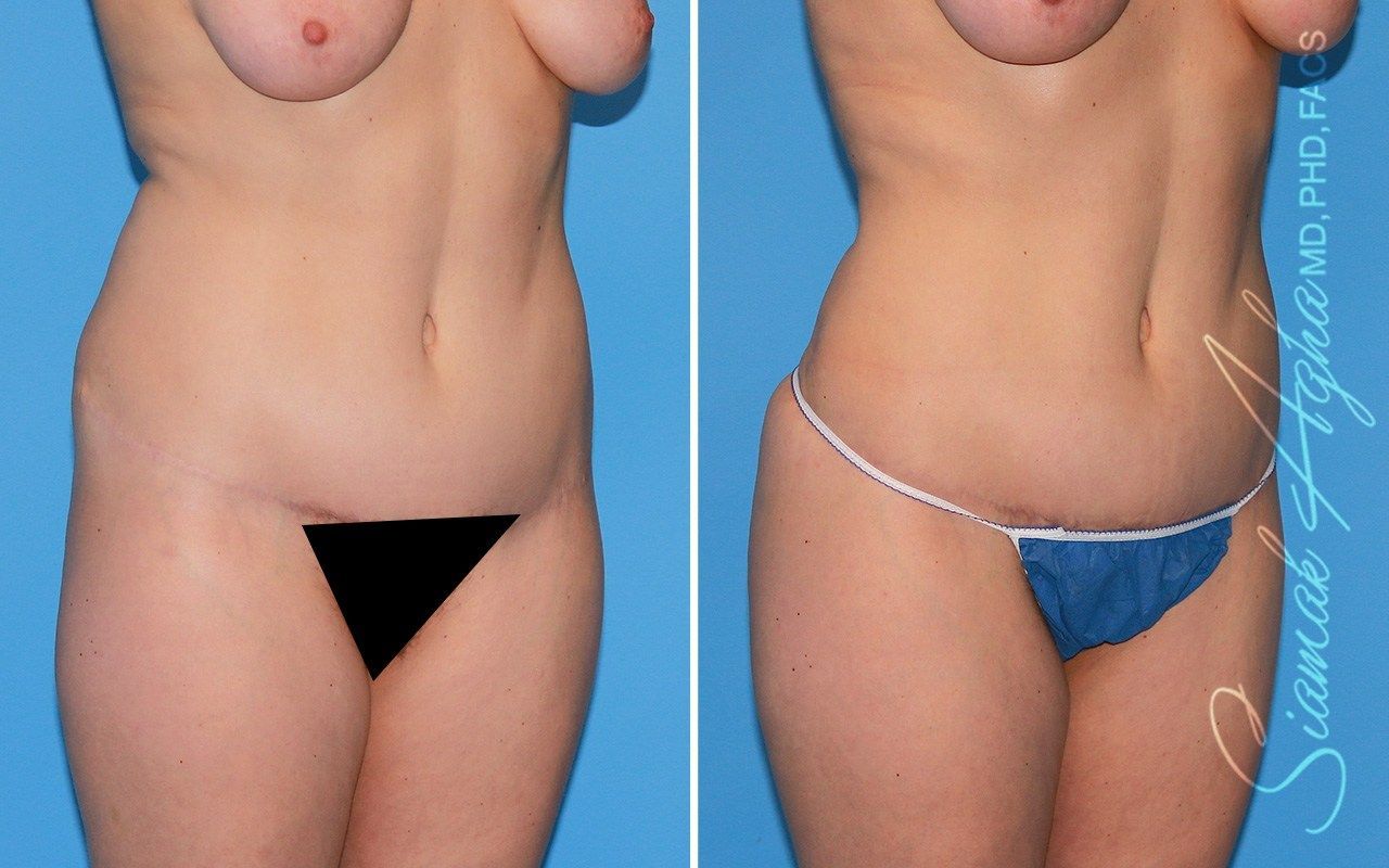 Combined Tummy Tuck Brazilian Butt Lift Before & After