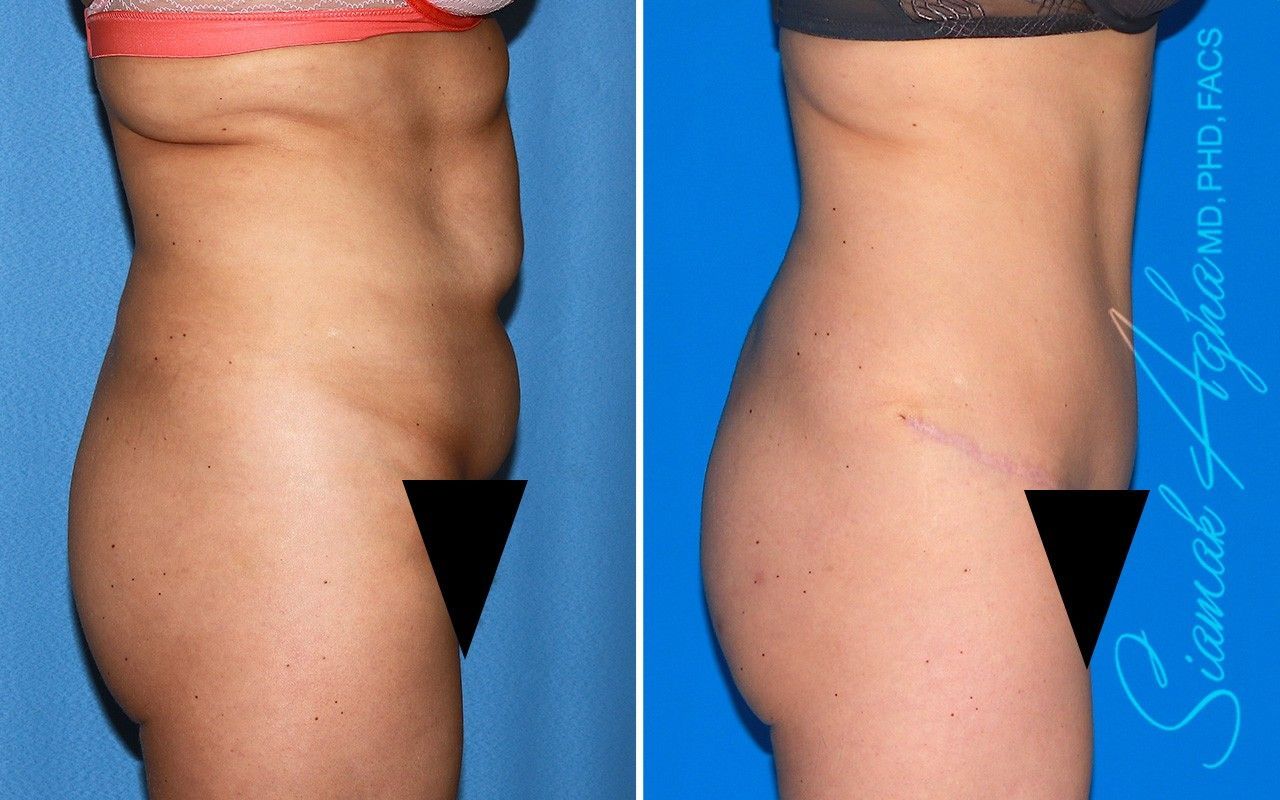 Combined Tummy Tuck Brazilian Butt Lift Before & After