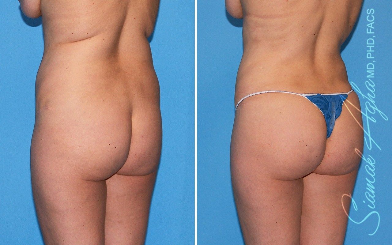 Combined Tummy Tuck Brazilian Butt Lift Before & After
