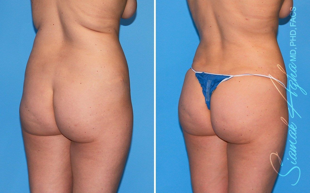 Combined Tummy Tuck Brazilian Butt Lift Before & After