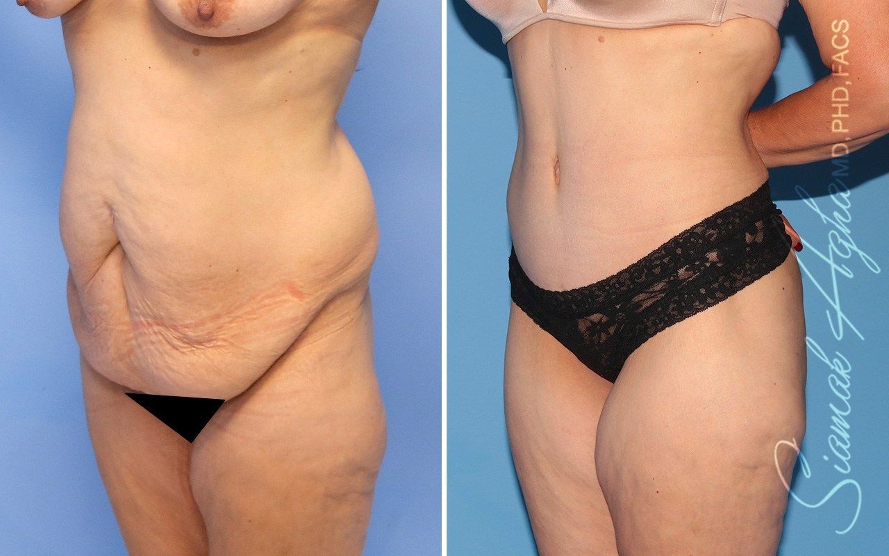 Combined Tummy Tuck Brazilian Butt Lift Before & After