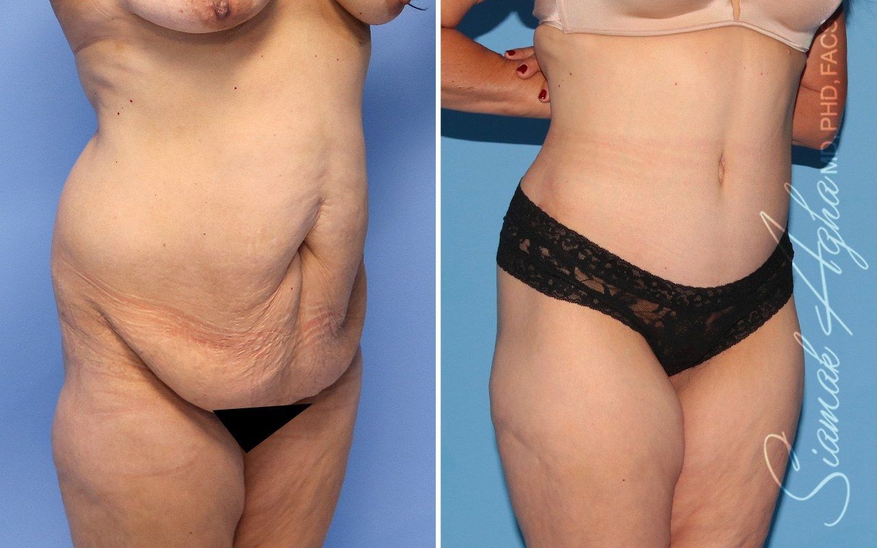Combined Tummy Tuck Brazilian Butt Lift Before & After