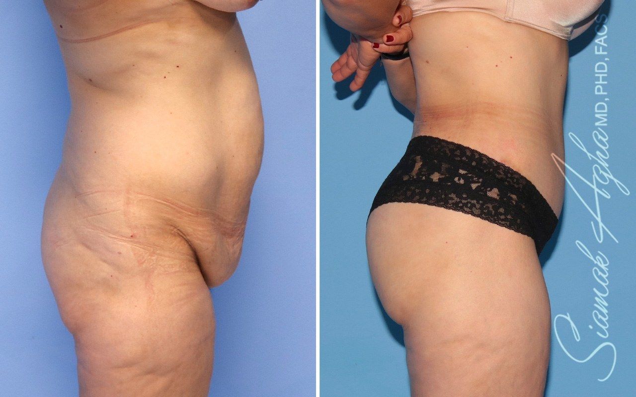Combined Tummy Tuck Brazilian Butt Lift Before & After