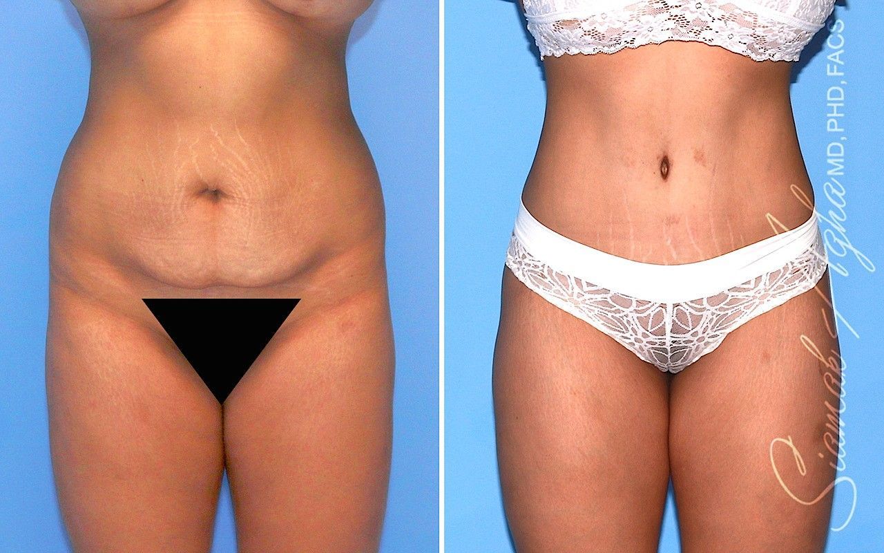 Combined Tummy Tuck Brazilian Butt Lift Before & After