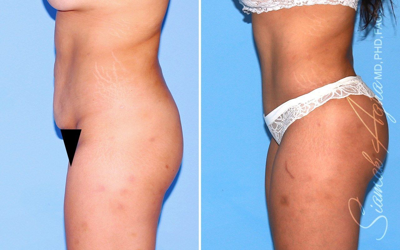 Combined Tummy Tuck Brazilian Butt Lift Before & After