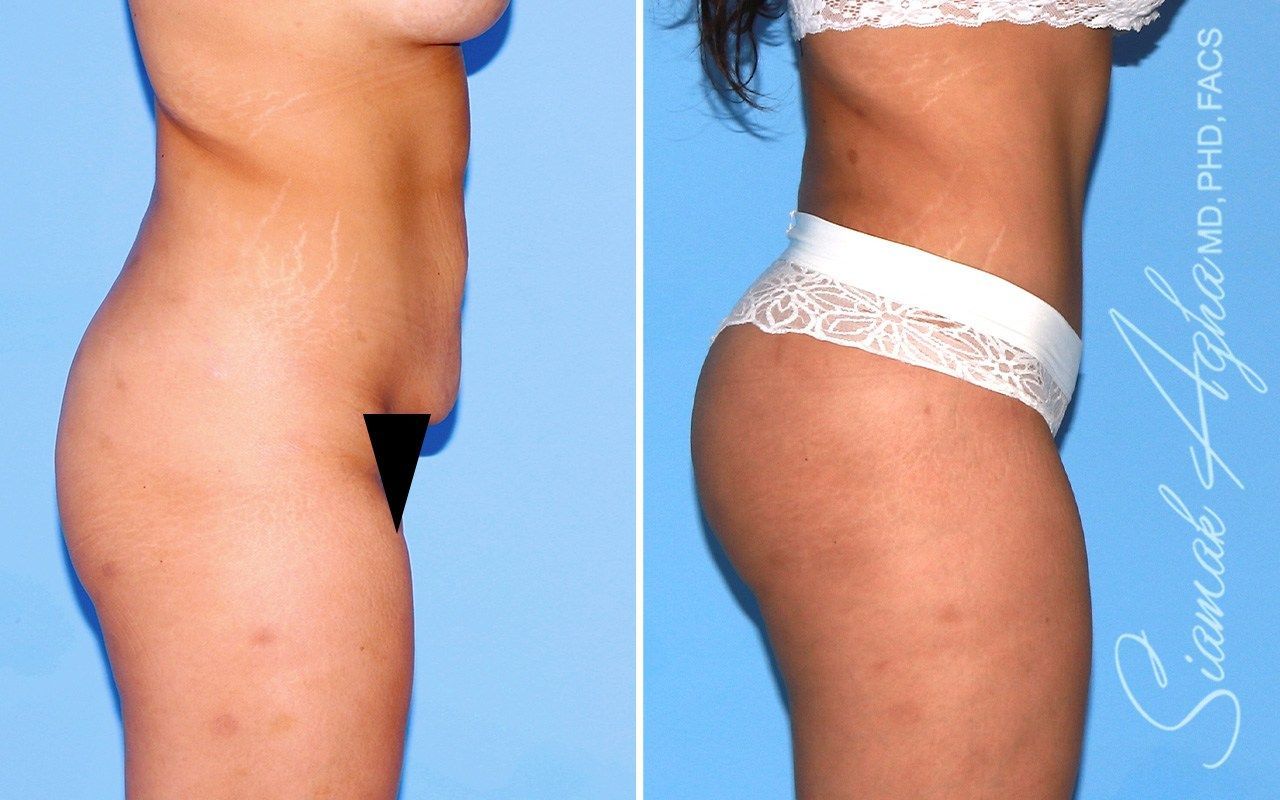 Combined Tummy Tuck Brazilian Butt Lift Before & After