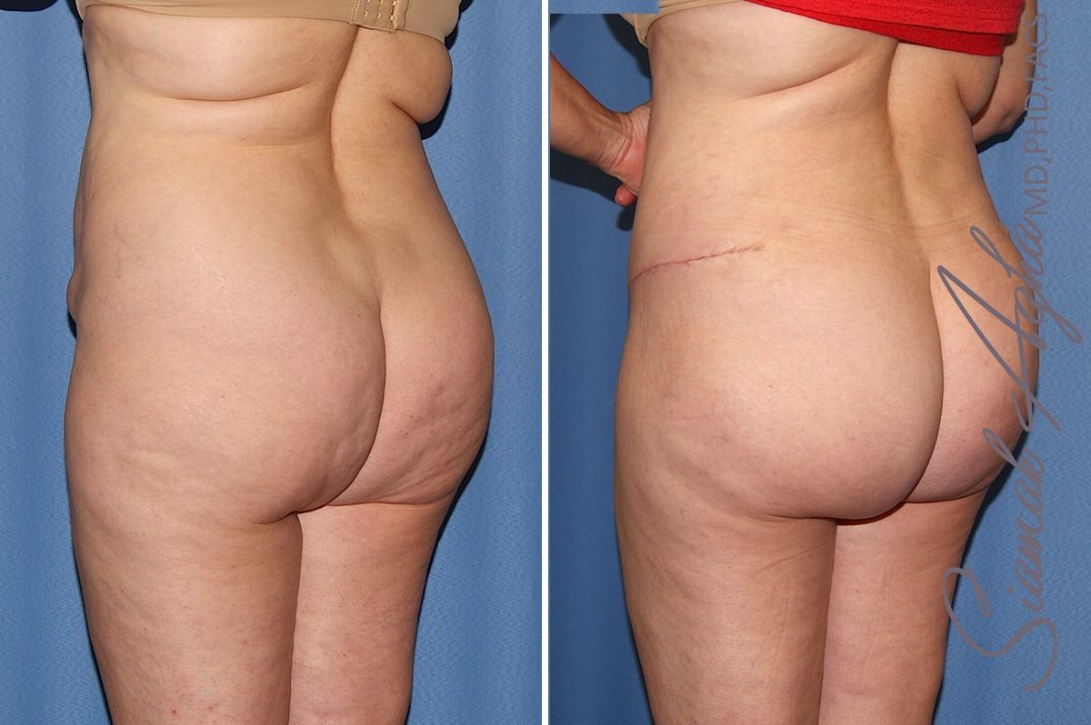 Combined Tummy Tuck Brazilian Butt Lift Before & After