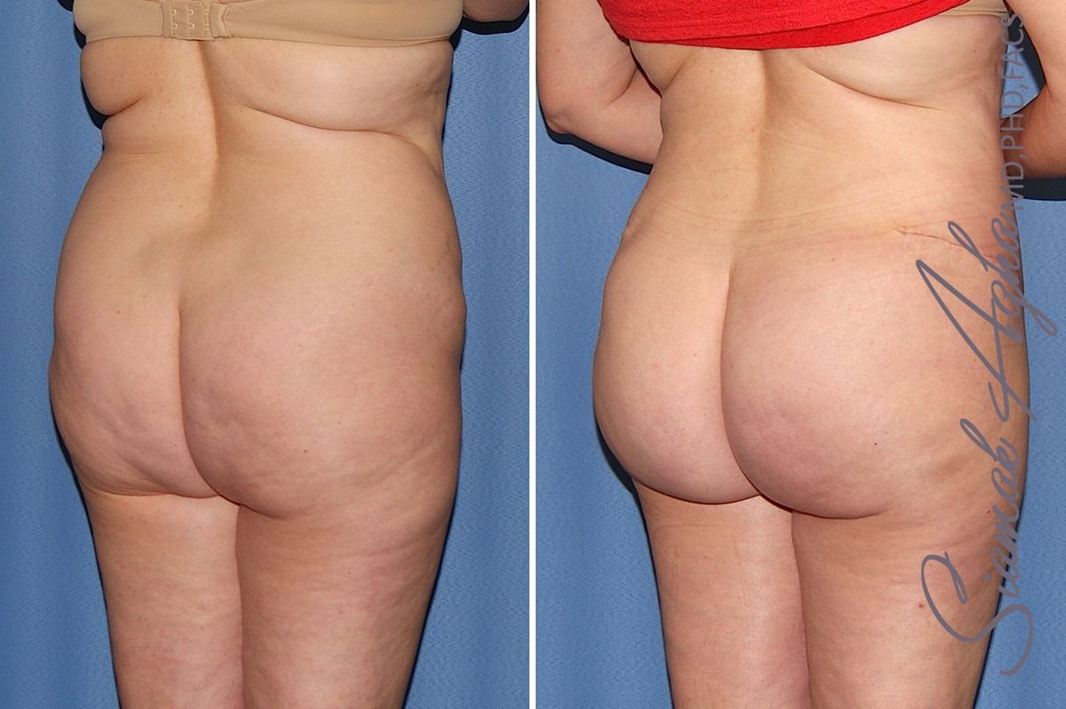 Combined Tummy Tuck Brazilian Butt Lift Before & After