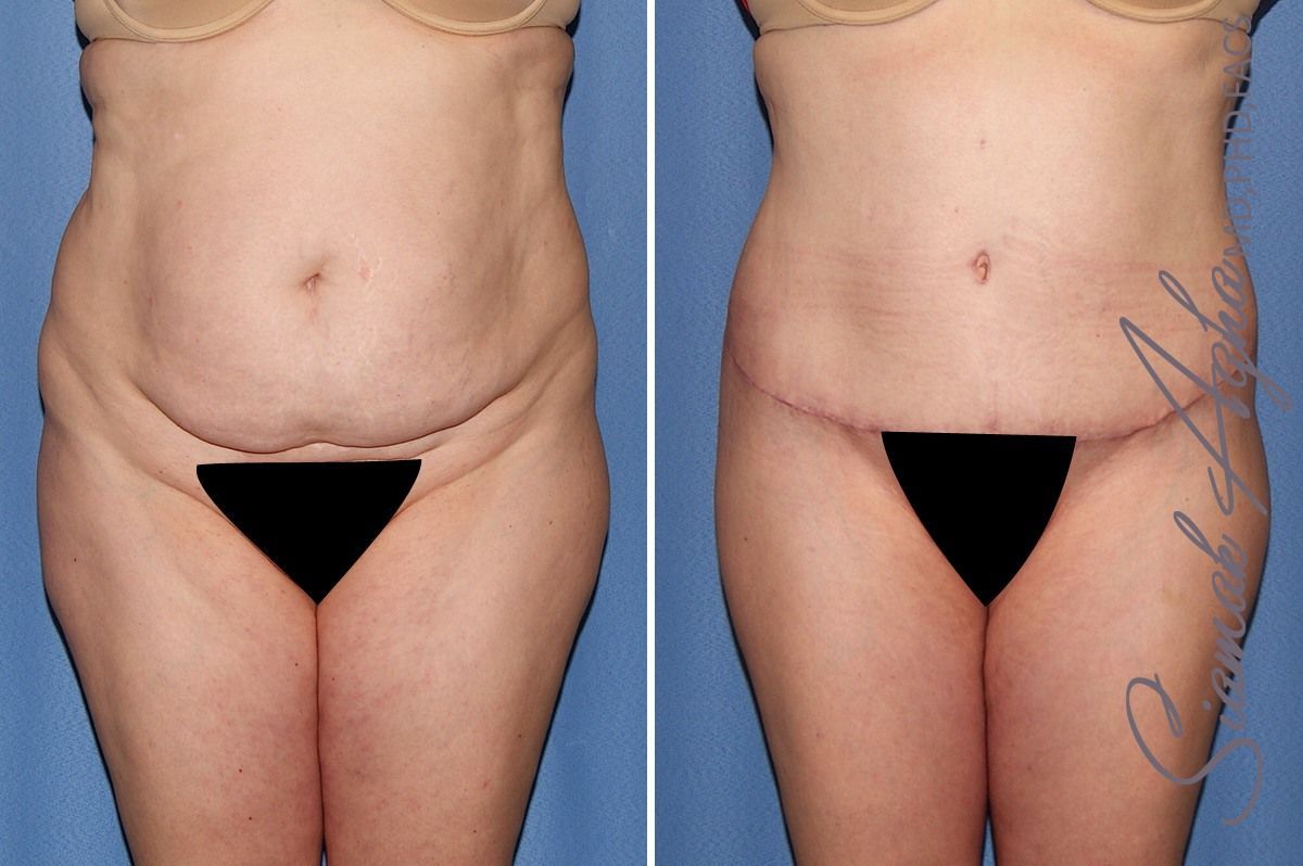 Combined Tummy Tuck Brazilian Butt Lift Before & After