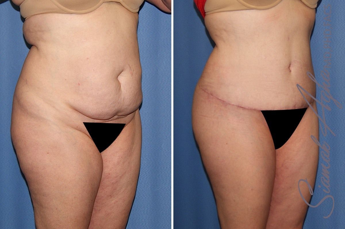 Combined Tummy Tuck Brazilian Butt Lift Before & After