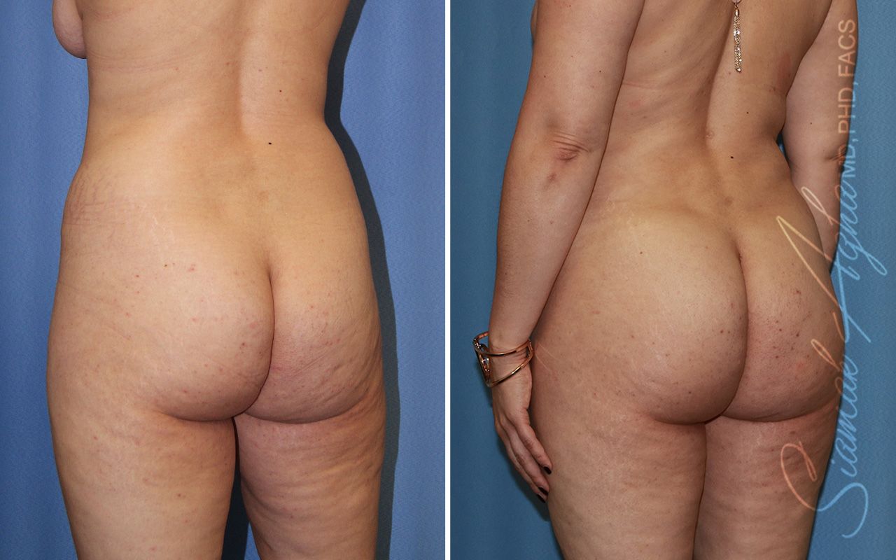 Combined Tummy Tuck Brazilian Butt Lift Before & After