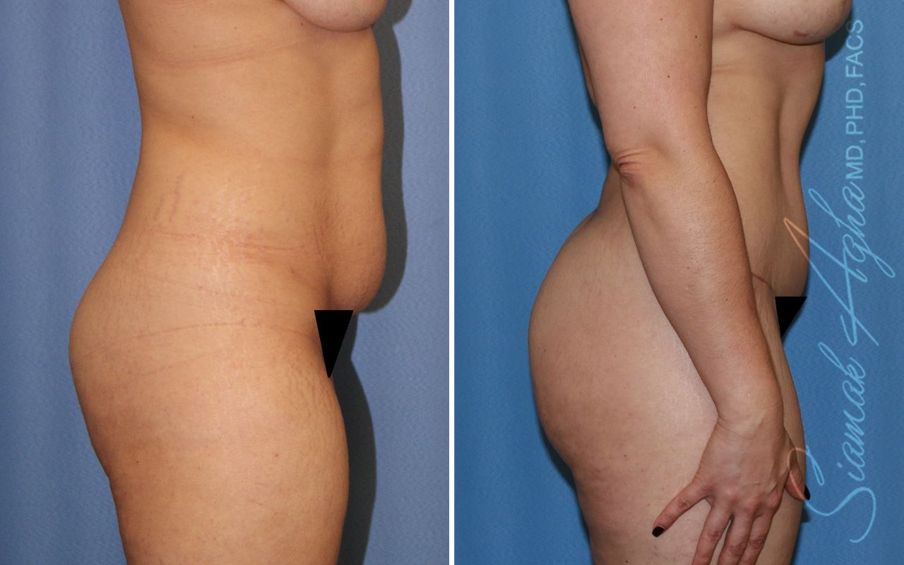 Combined Tummy Tuck Brazilian Butt Lift Before & After