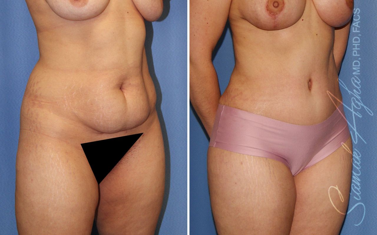 Combined Tummy Tuck Brazilian Butt Lift Before & After
