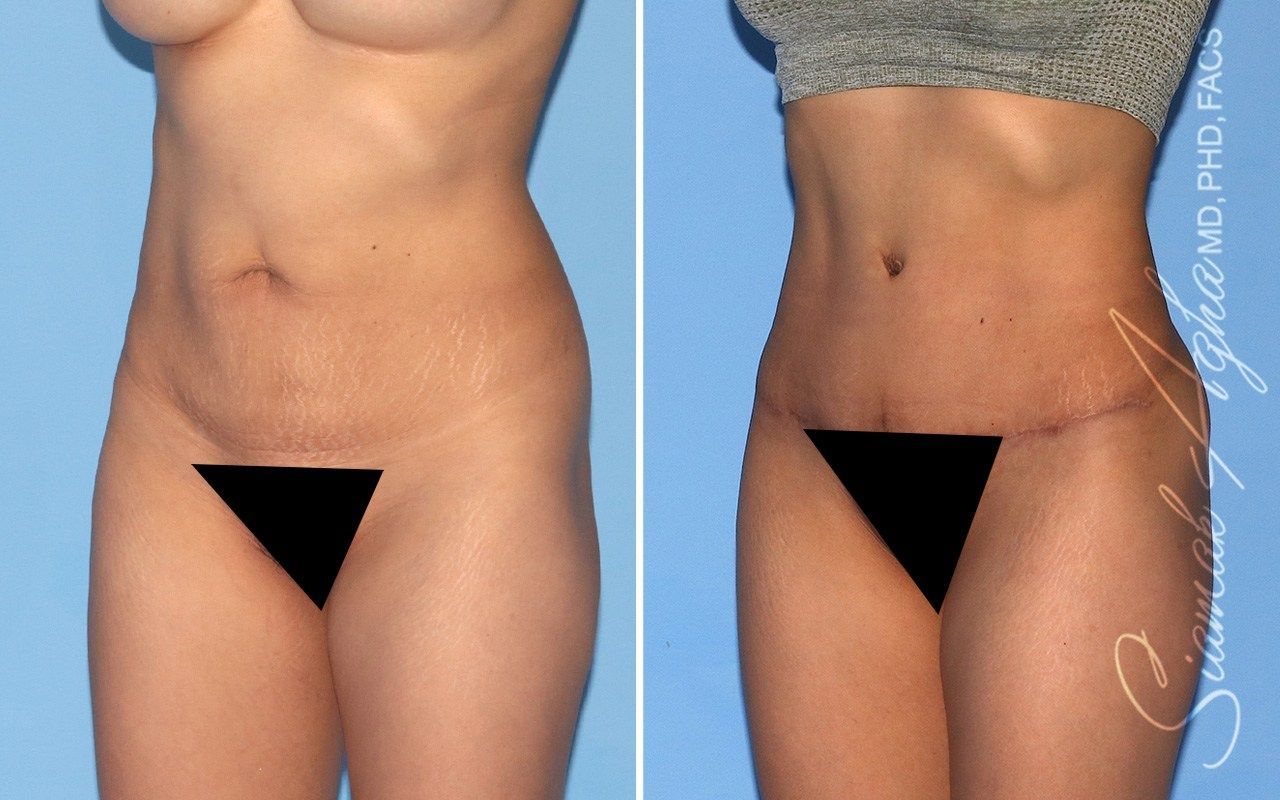 Combined Tummy Tuck Brazilian Butt Lift Before & After