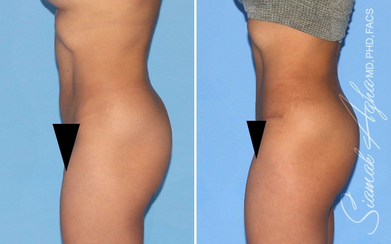 Combined Tummy Tuck Brazilian Butt Lift Before & After