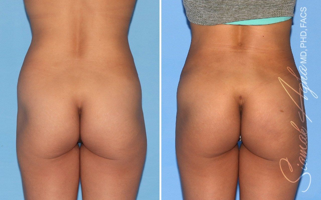 Combined Tummy Tuck Brazilian Butt Lift Before & After
