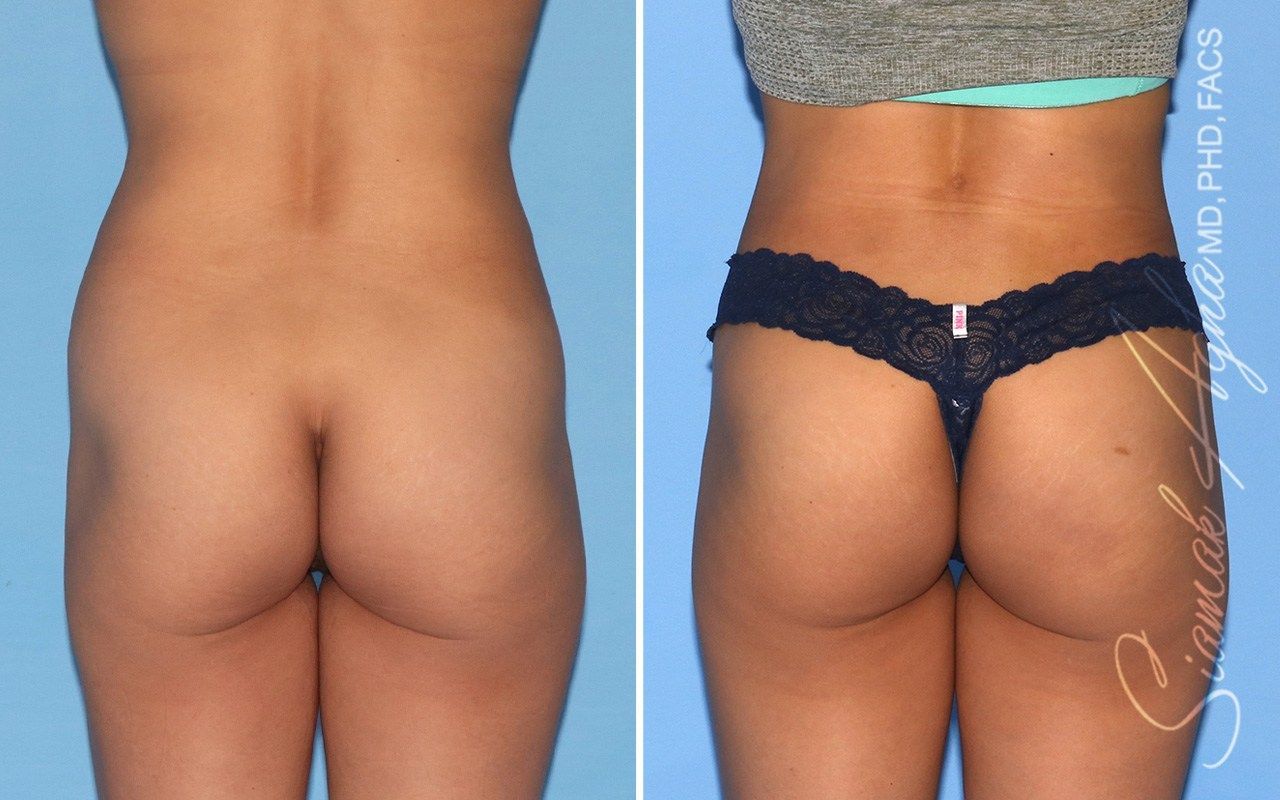 Combined Tummy Tuck Brazilian Butt Lift Before & After