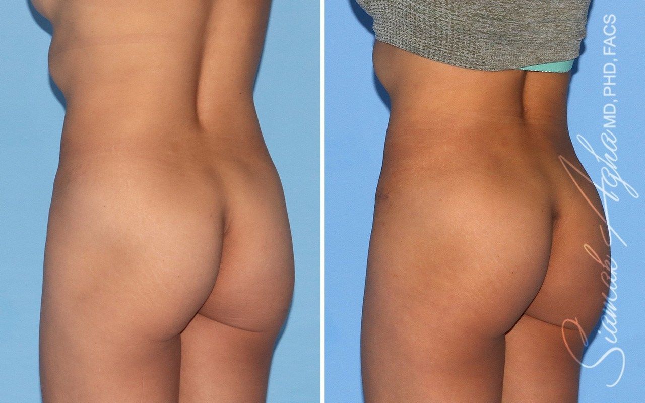 Combined Tummy Tuck Brazilian Butt Lift Before & After