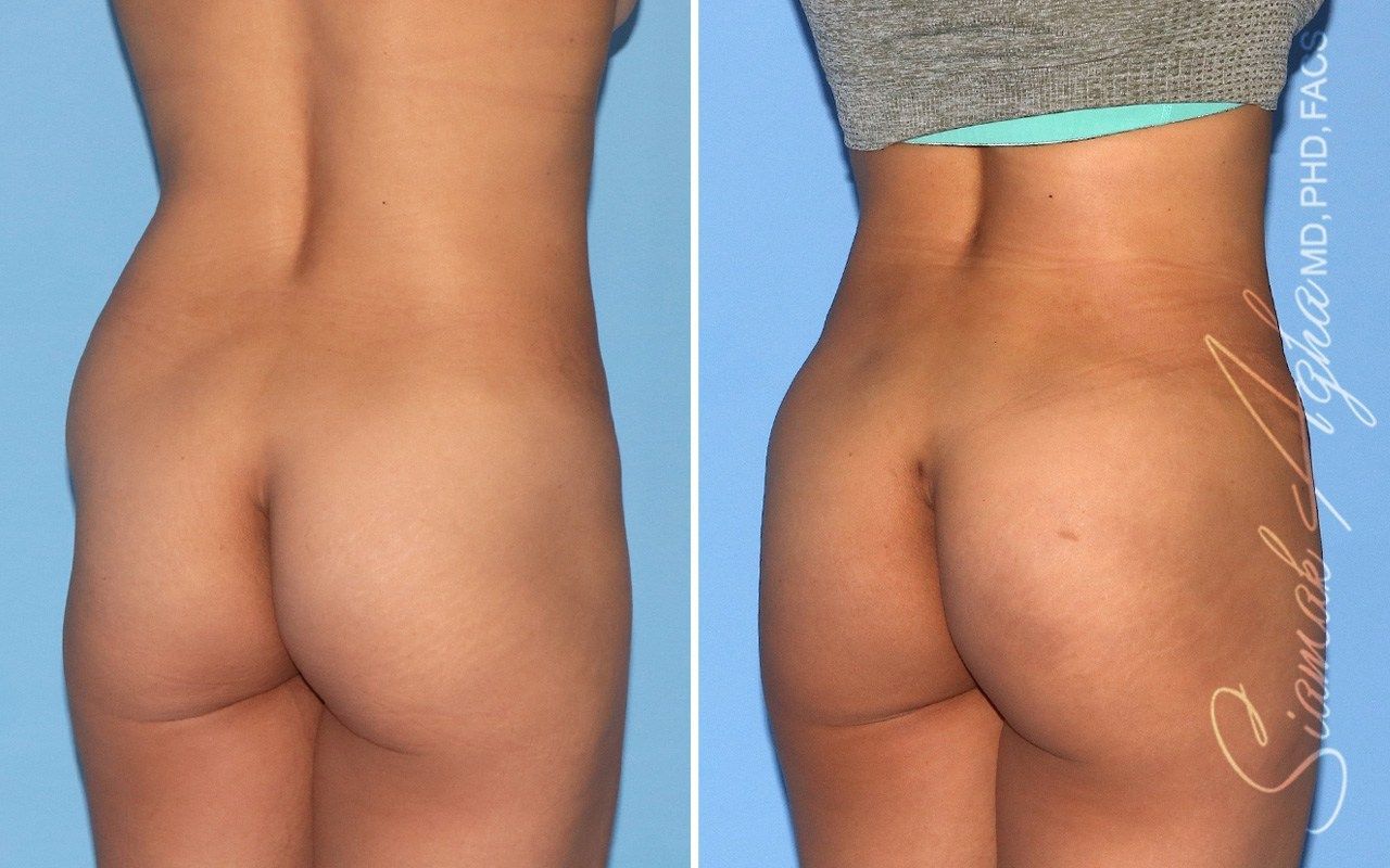Combined Tummy Tuck Brazilian Butt Lift Before & After
