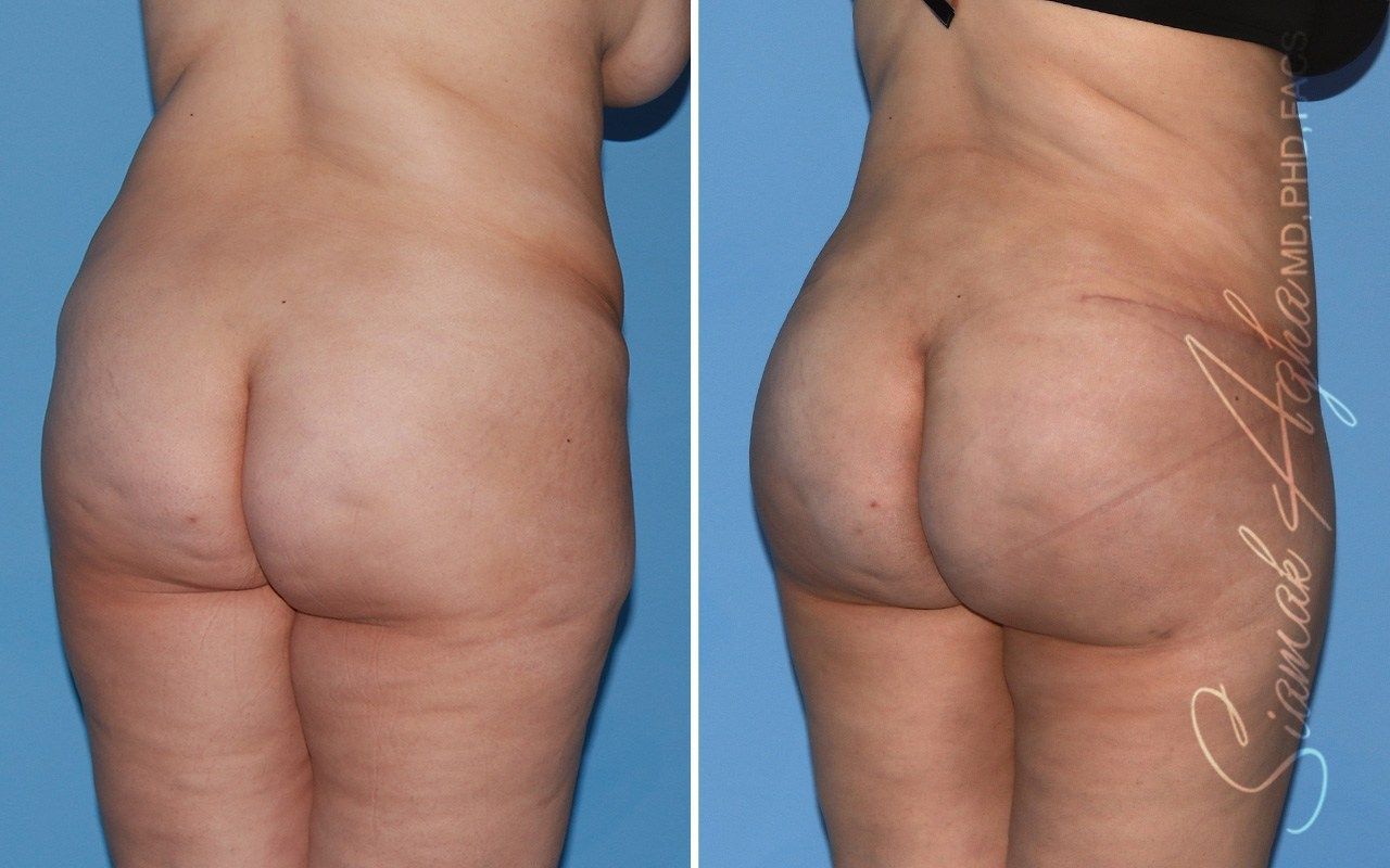 Combined Tummy Tuck Brazilian Butt Lift Before & After