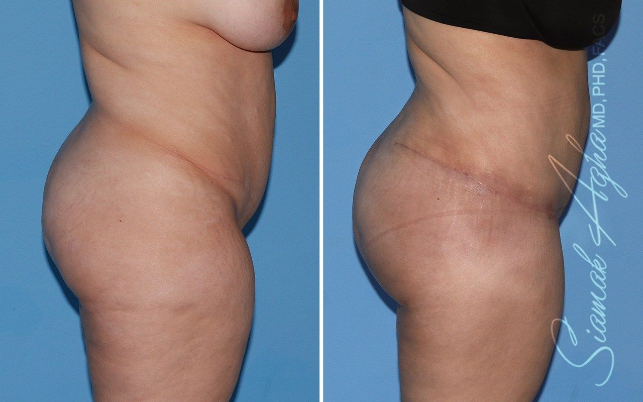 Combined Tummy Tuck Brazilian Butt Lift Before & After