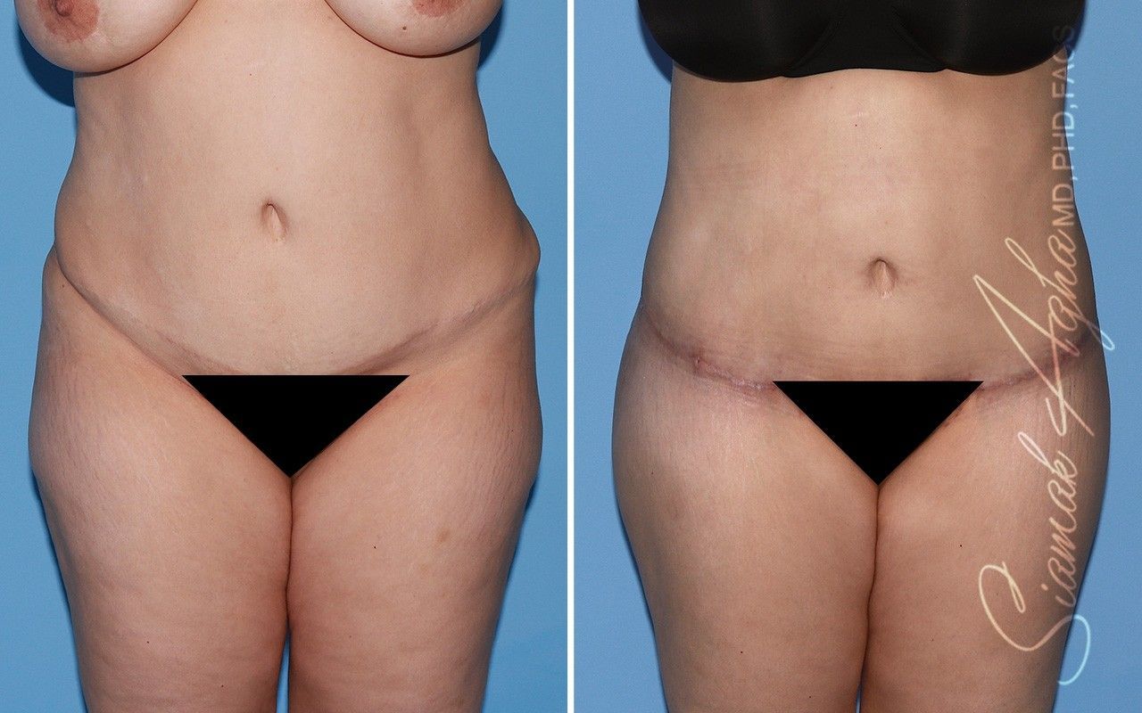 Combined Tummy Tuck Brazilian Butt Lift Before & After
