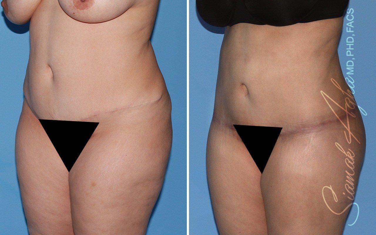Combined Tummy Tuck Brazilian Butt Lift Before & After