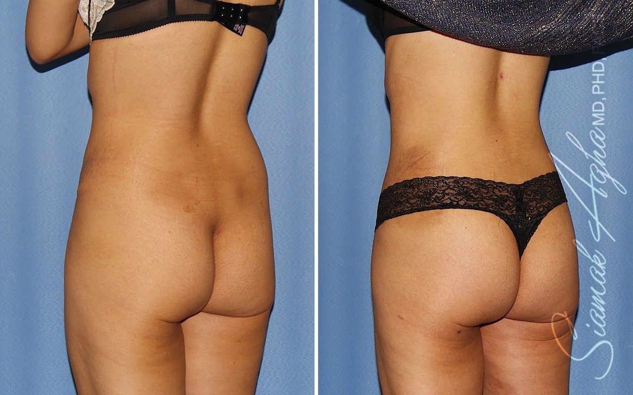 Combined Tummy Tuck Brazilian Butt Lift Before & After