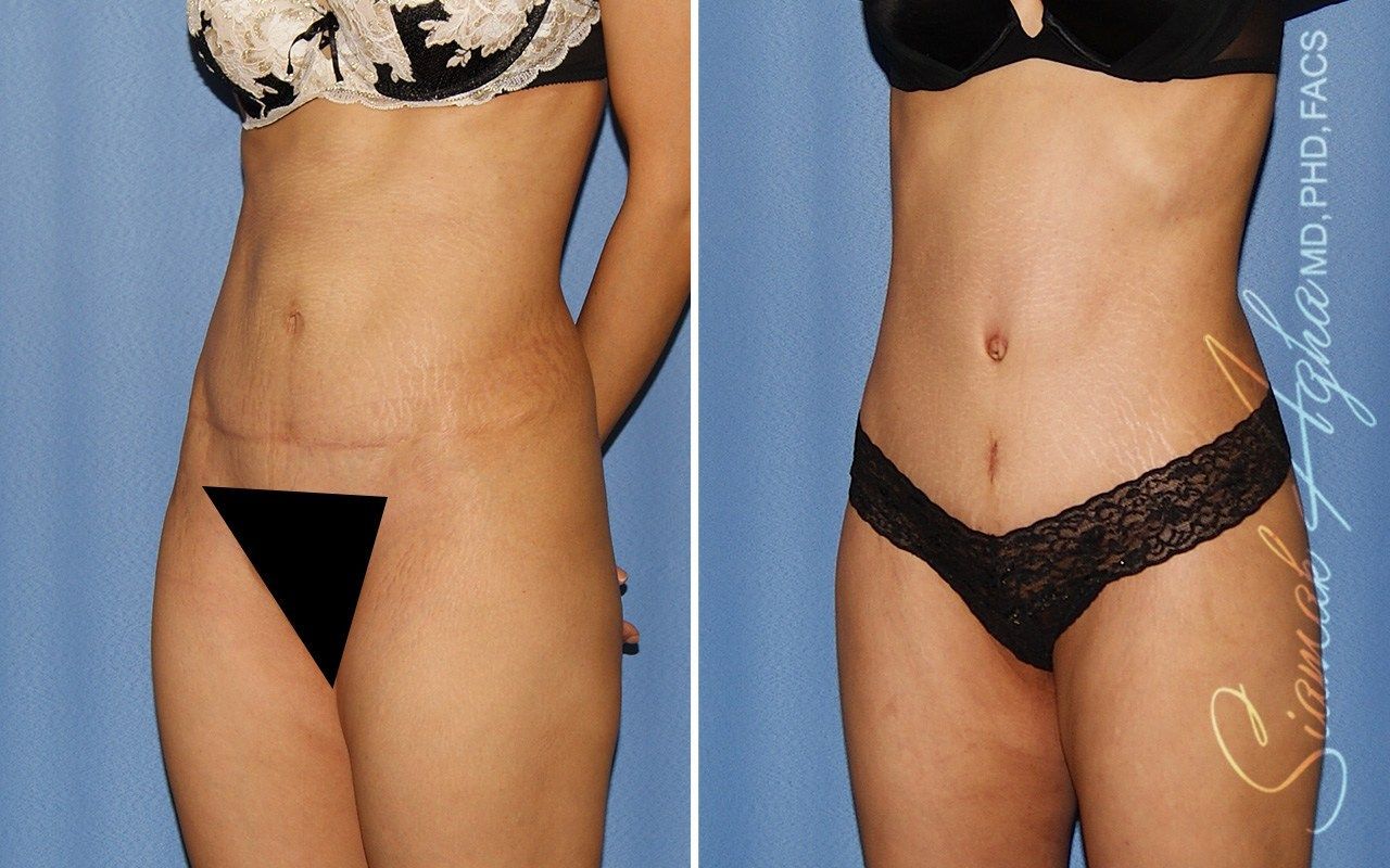 Combined Tummy Tuck Brazilian Butt Lift Before & After