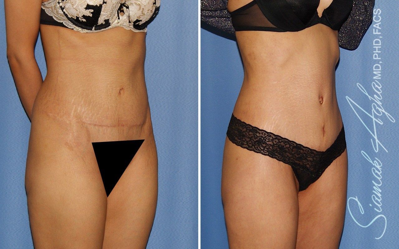 Combined Tummy Tuck Brazilian Butt Lift Before & After