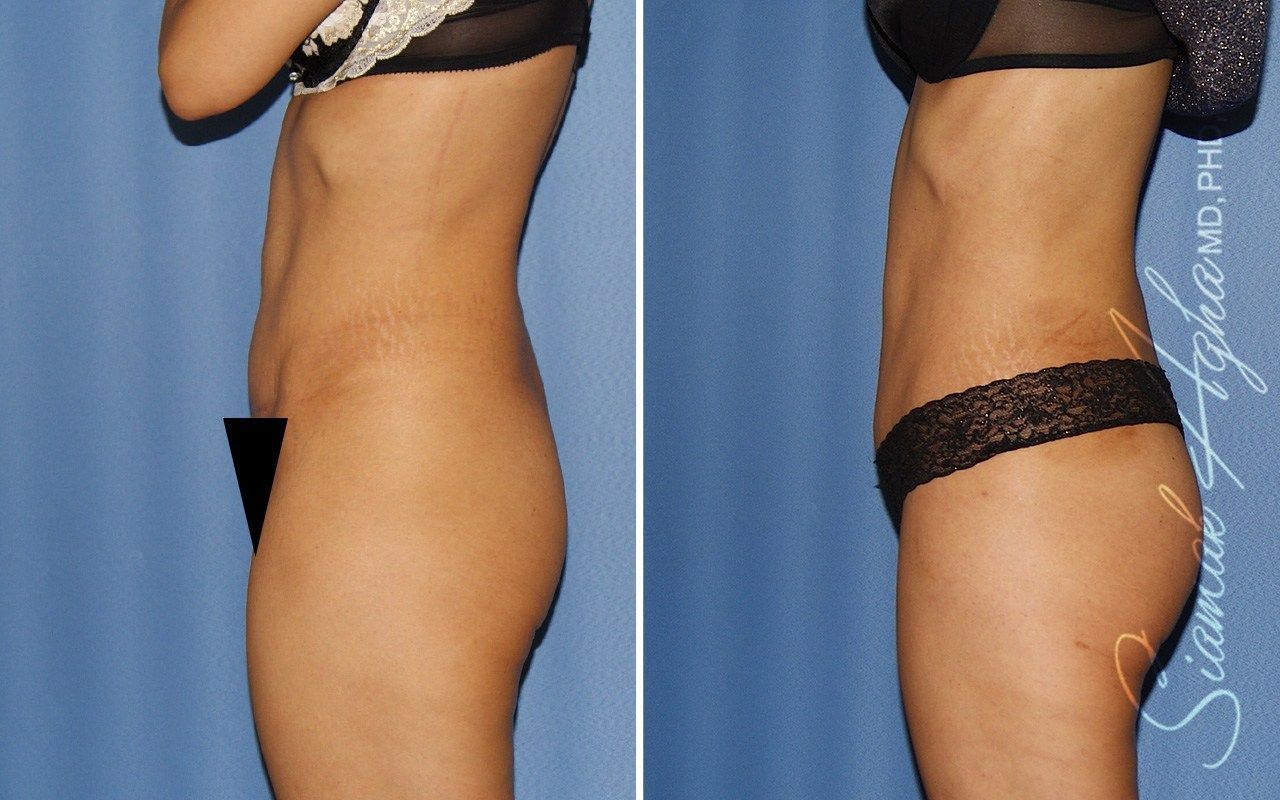 Combined Tummy Tuck Brazilian Butt Lift Before & After