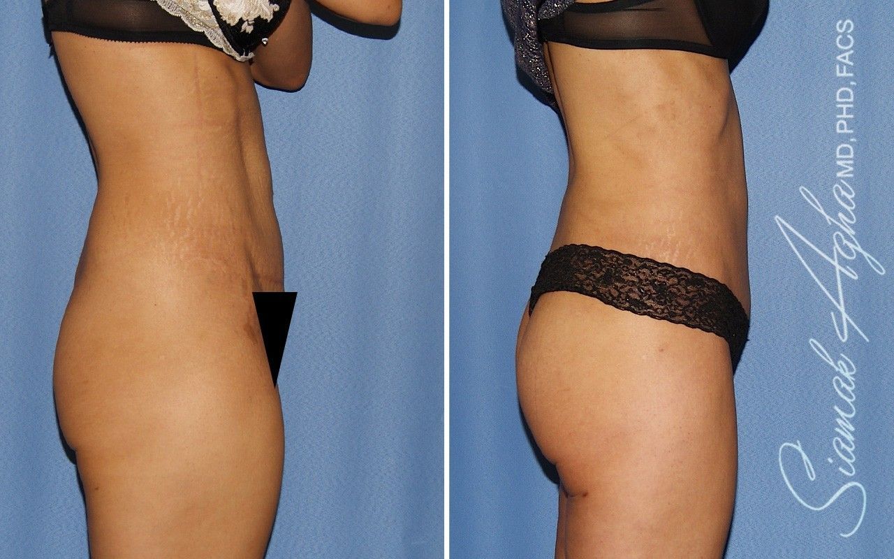 Combined Tummy Tuck Brazilian Butt Lift Before & After